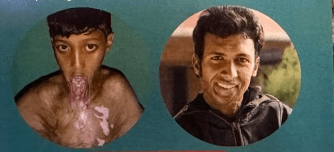 A Scar That Tells a Story: Mr. Tej B.K’s Journey