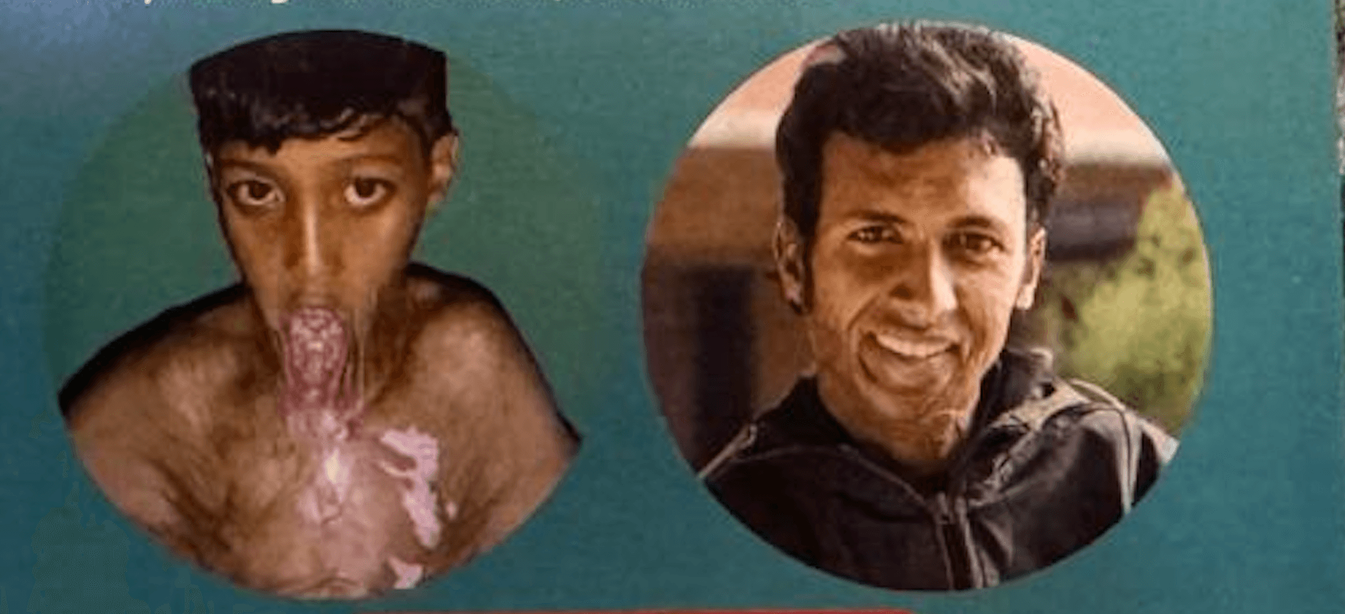 A Scar That Tells a Story: Mr. Tej B.K’s Journey