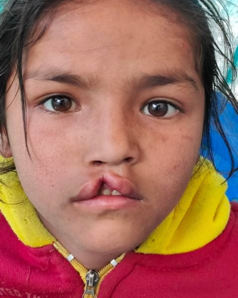 Cleft Lip and Palate Surgery